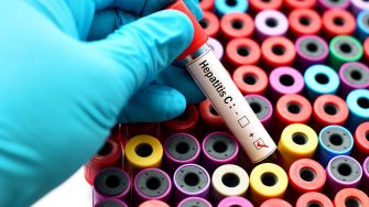 Blood sample positive with hepatitis C virus