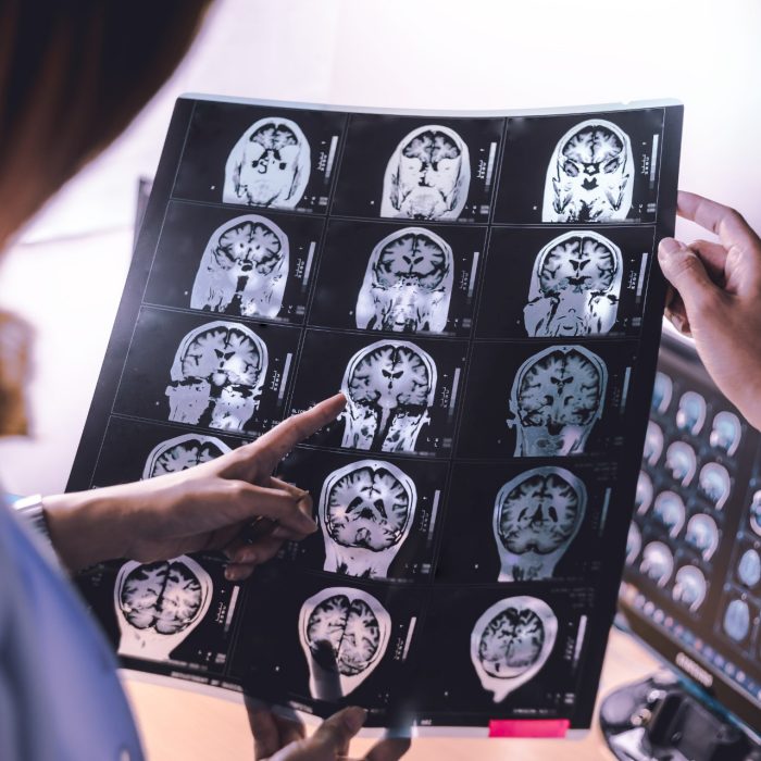 brain atrophy on MRI of Dementia patient
