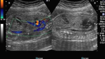 Doppler image of fetal aorta © Dr. Joe Antony