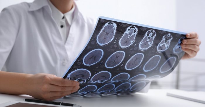 Multiple Sclerosis Rates Soar in Australia, Silver Linings Emerge ...