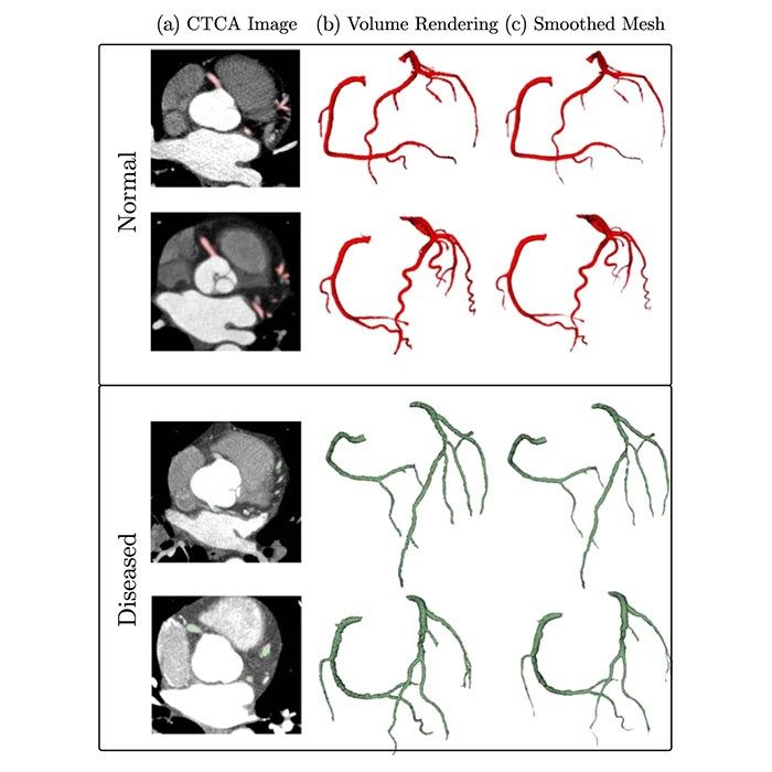 Annotated computed tomography coronary angiogram images and associated data of normal and diseased arteries