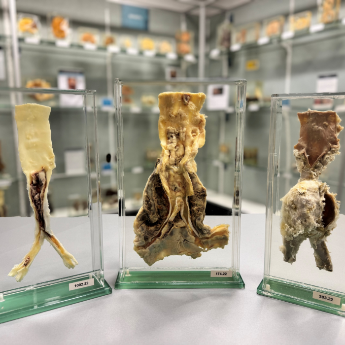 Arteries demonstrating atherosclerosis