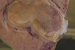 cysts