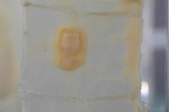 Lesion