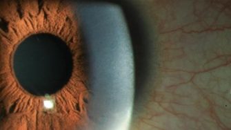 A picture of an Eyeball with Keratitis