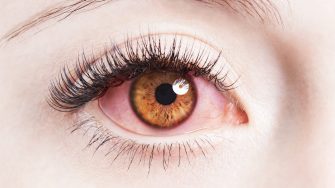 Close up image of human irritated red bloodshot eye