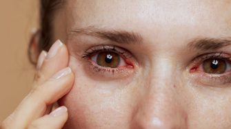 Closeup on young woman with inflamed eyes.
