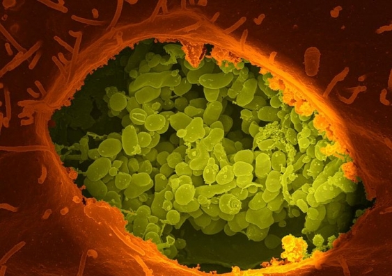 Electron microscope image of a human cell vacuole where the bacterium that causes Q Fever (Coxiella burnetii) is busy growing. Wikimedia