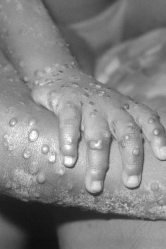 Close-up of monkeypox lesions on the arm and leg of a female child.