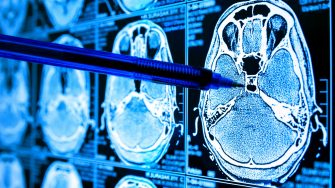 A pen points to a region of a brain scan on a computer monitor