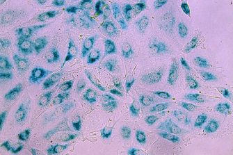 Breast cancer cells in their 'sleeping' state (senescence) after treatment. When the JNK pathway is disrupted, cancer cells fail are less likely to enter this state and continue dividing, leading to therapy resistance.