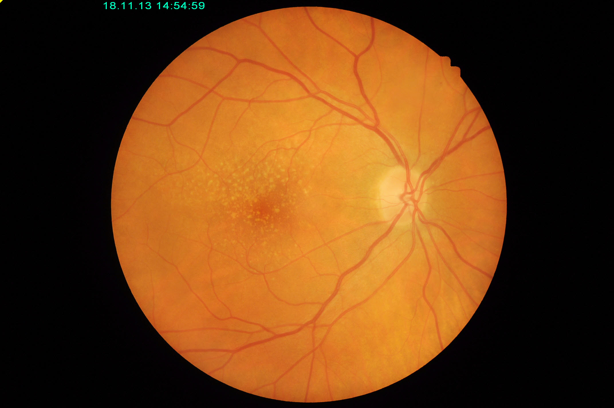 Signs of macular degeneration (via little lumps) in an image of the retina.
