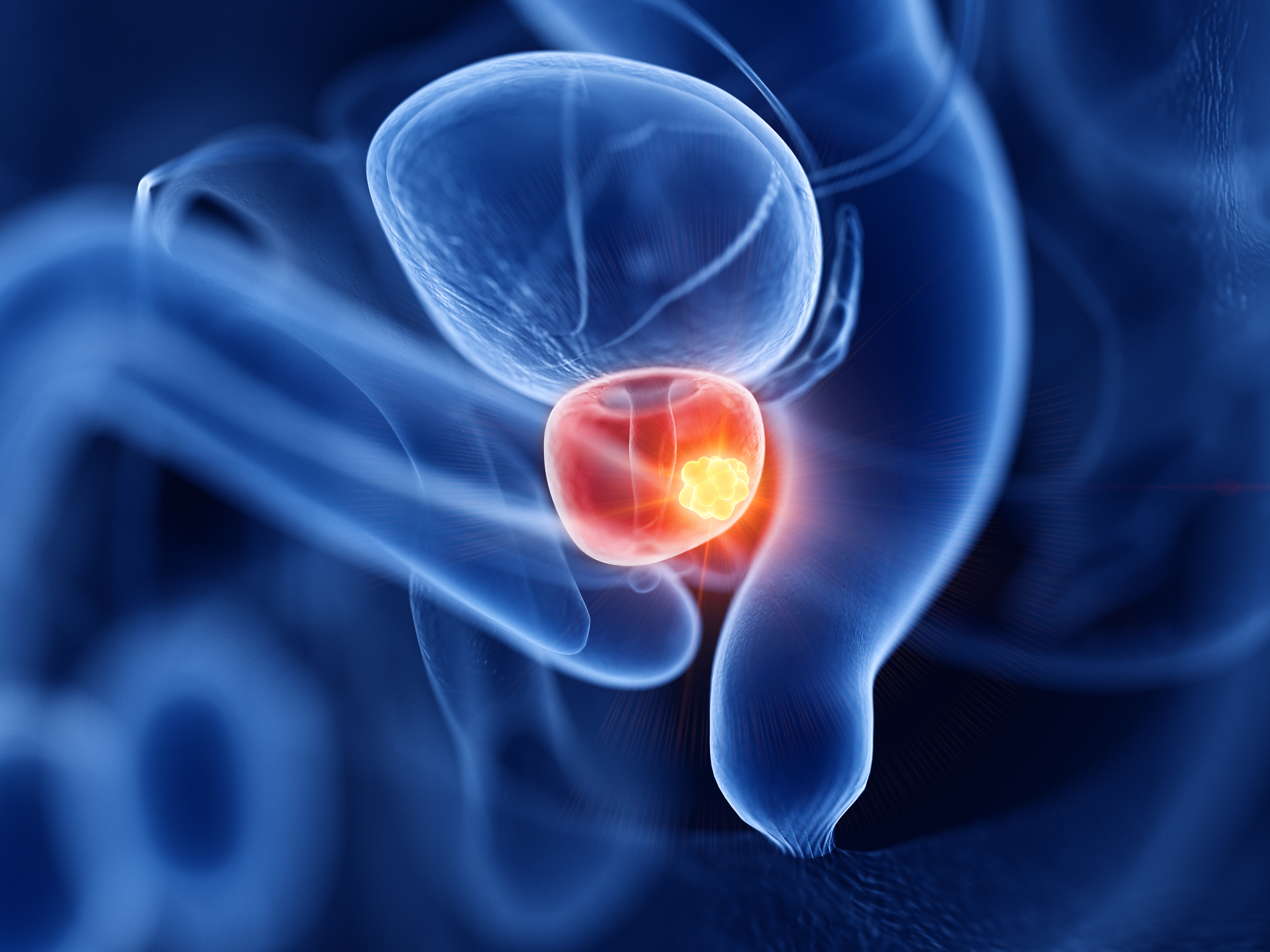3d rendered medically accurate illustration of prostate cancer