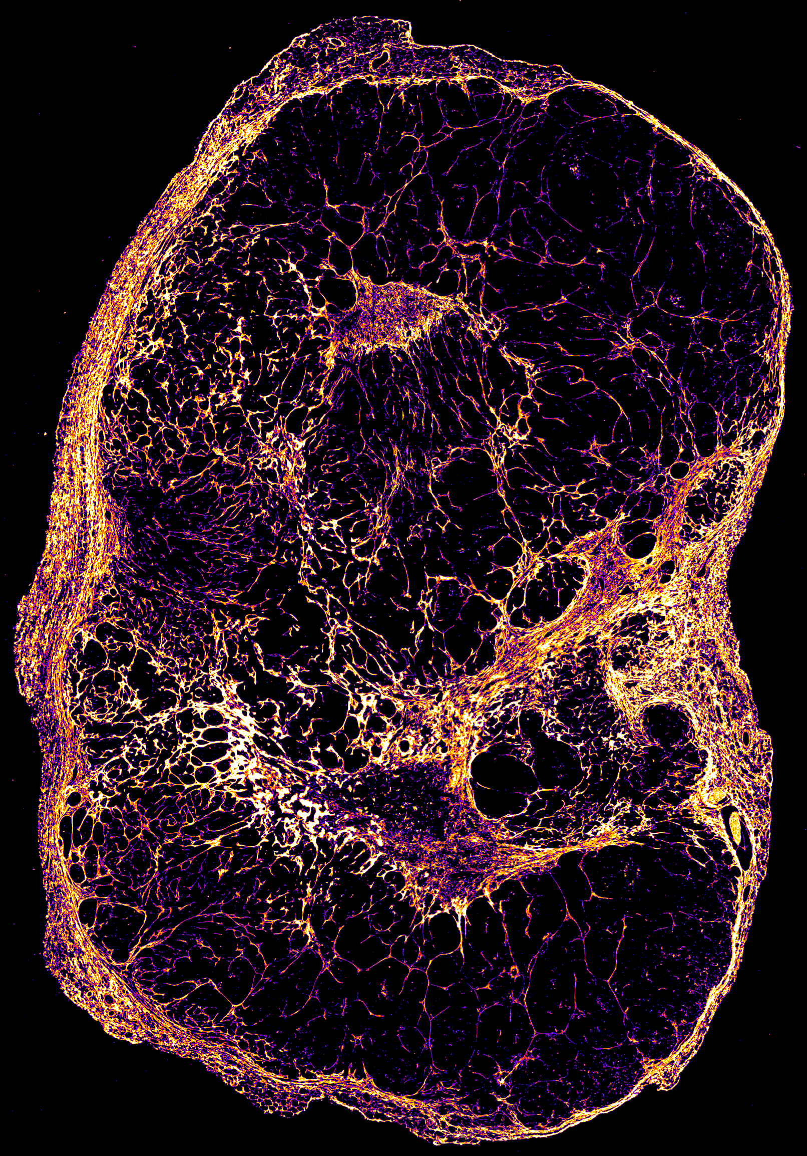A microscopic view of a slow-growing breast cancer tumour