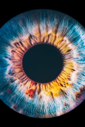 Signs of macular degeneration (via little lumps) in an image of the retina.