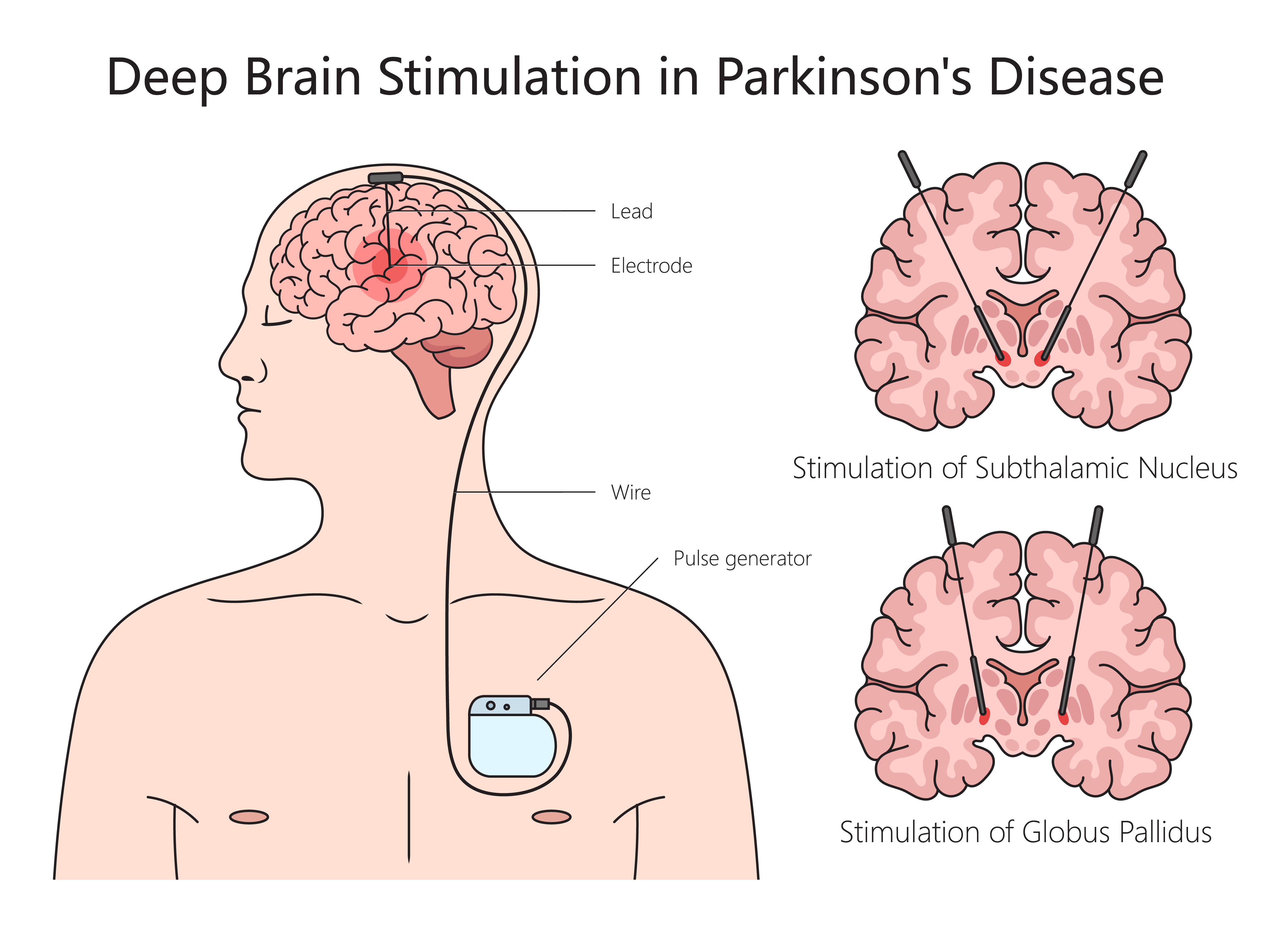 An illustration of deep brain stimulation for Parkinson's Disease.