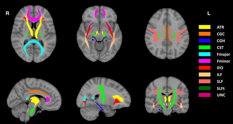 ATR, Anterior thalamic radiation; CGC, Cingulum (cingulate gyrus); CGH, Cingulum (hippocampus); CST, Corticospinal tract; Fmajor, Forceps major; Fminor, Forceps minor; IFO, Inferior fronto-occipital fasciculus; ILF, Inferior longitudinal fasciculus; SLF, Superior longitudinal fasciculus; SLFt, Superior longitudinal fasciculus (temporal part); UNC, Uncinate fasciculus 