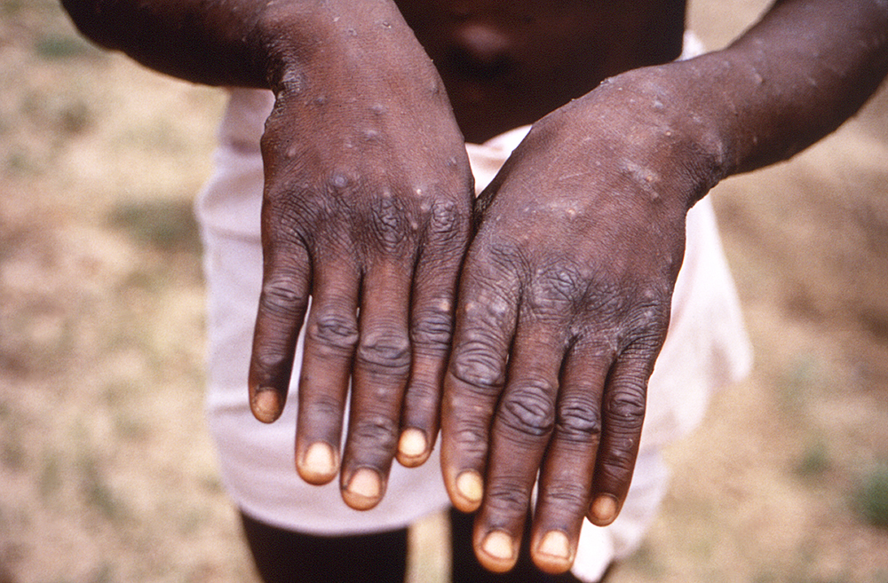 Monkeypox rash in an infected man in the Democratic Republic of the Congo.