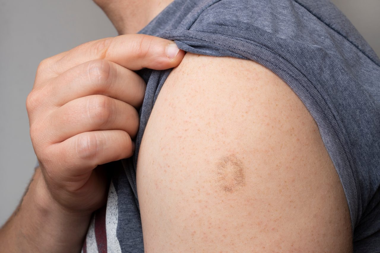 A person lifts their t-shirt to reveal a smallpox vaccination scar