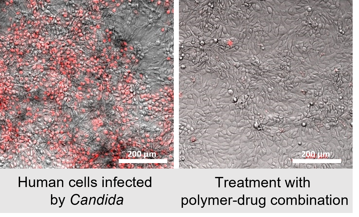 Visualisation of effect on human cells infected by Candida when treated during the research with a polymer-drug combination.