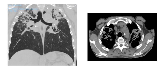 CT scans in front view and cross-sectional view of the chest of a construction worker diagnosed with silicosis. The light grey areas indicate scarring of the lung tissue.