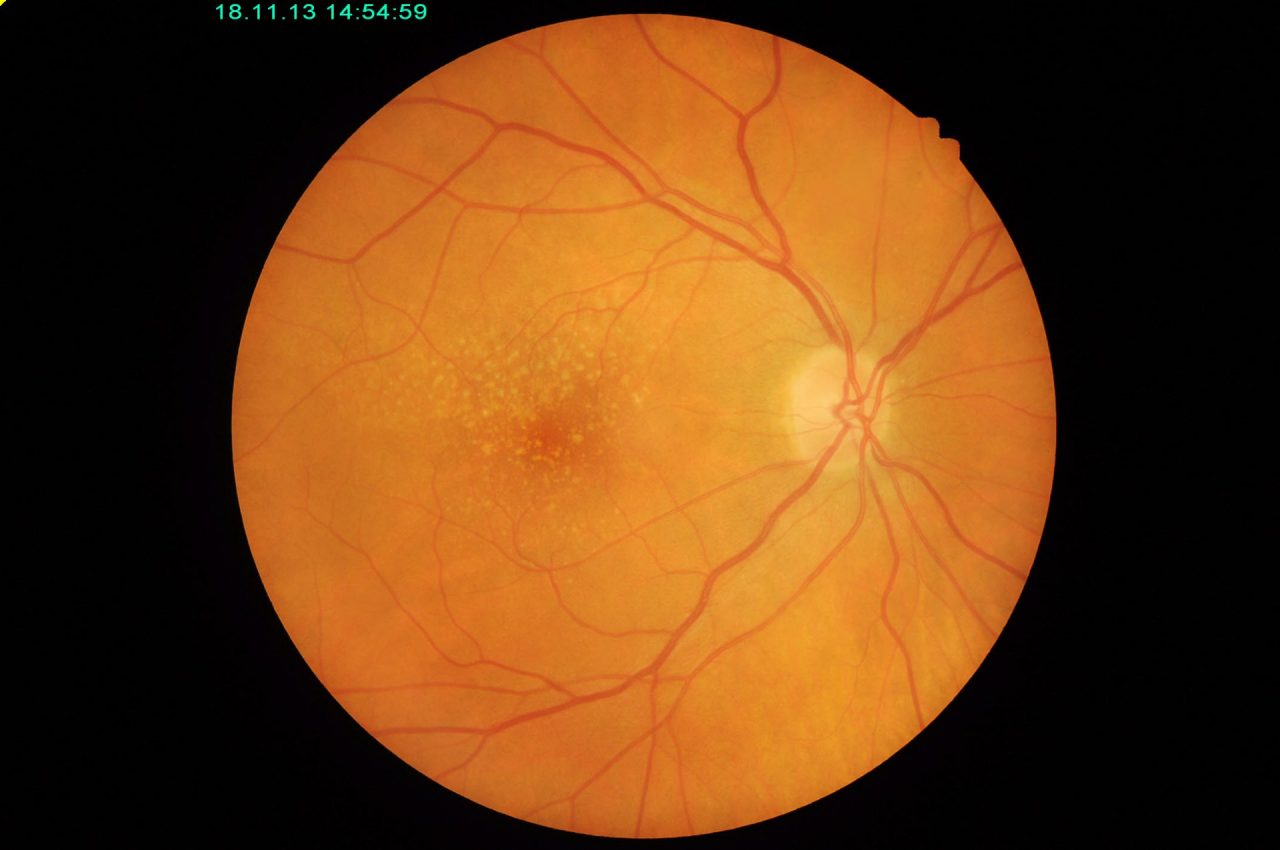 Signs of macular degeneration (via little lumps) in an image of the retina.